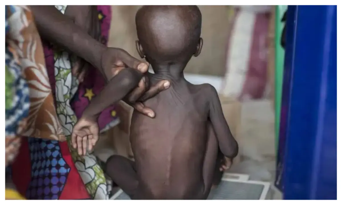 Nigeria has highest burden of malnourished children in Africa – UNICEF